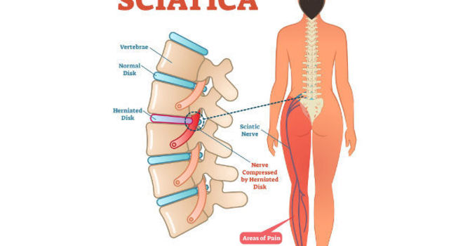 Sciatica Explained: Everything you need to know image